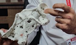 60 yaşındaki kadın 3D yazıcıyla üretilen kalça proteziyle sağlığına kavuştu